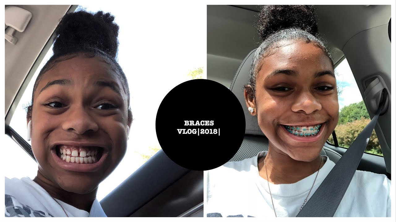 BRACES VLOG 2O18