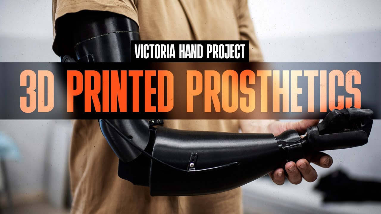 Victoria Hand Project: Changing Prosthetic Care with 3D Printing