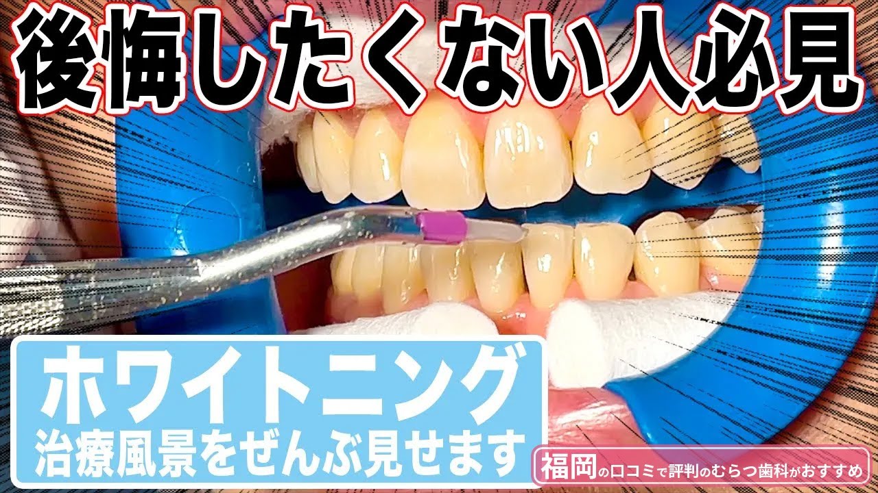 ※後悔する前に見てください。ホワイトニングで本当に白くするために必要なのはコレです。これから審美治療をやりたい方におすすめです。【福岡 博多の口コミで評判の歯科医が解説】