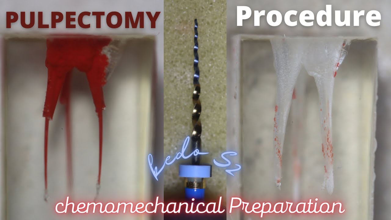 Chemomechanical Preparation with Kedo S2 Plus🔵 Pulpectomy