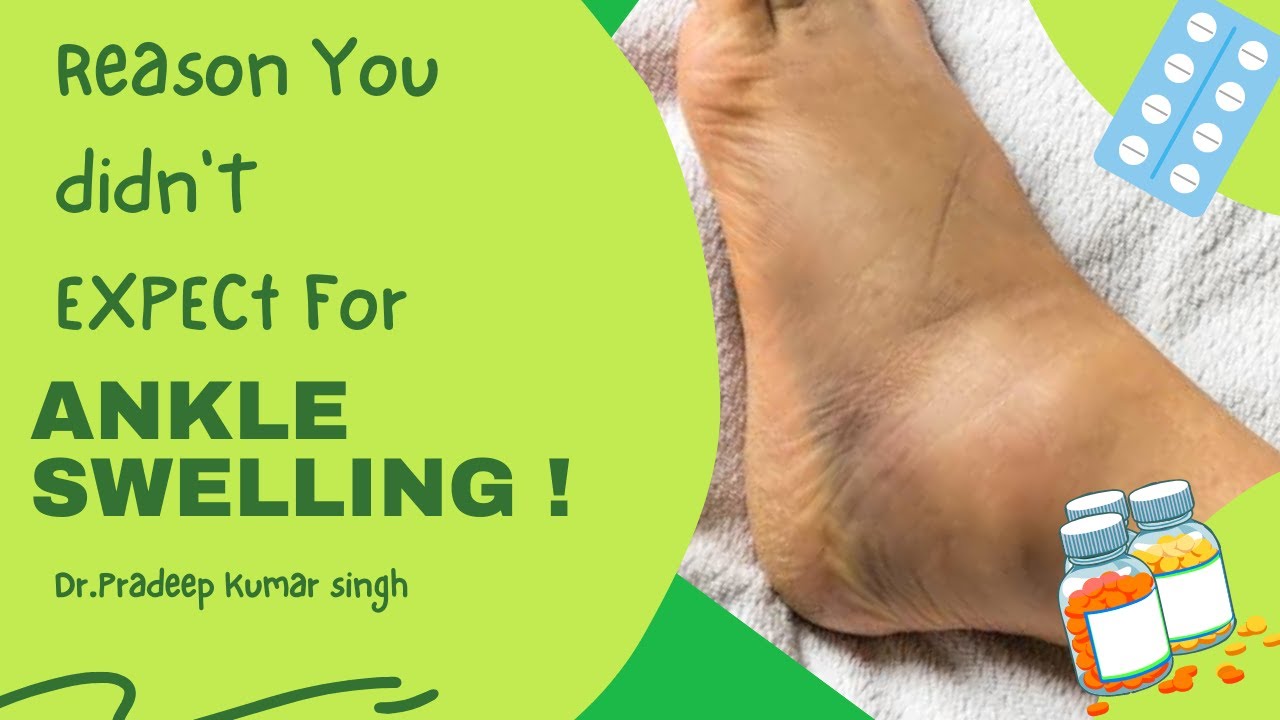 Reasons for Ankle Swelling/Dr. Pradeep Kumar Singh