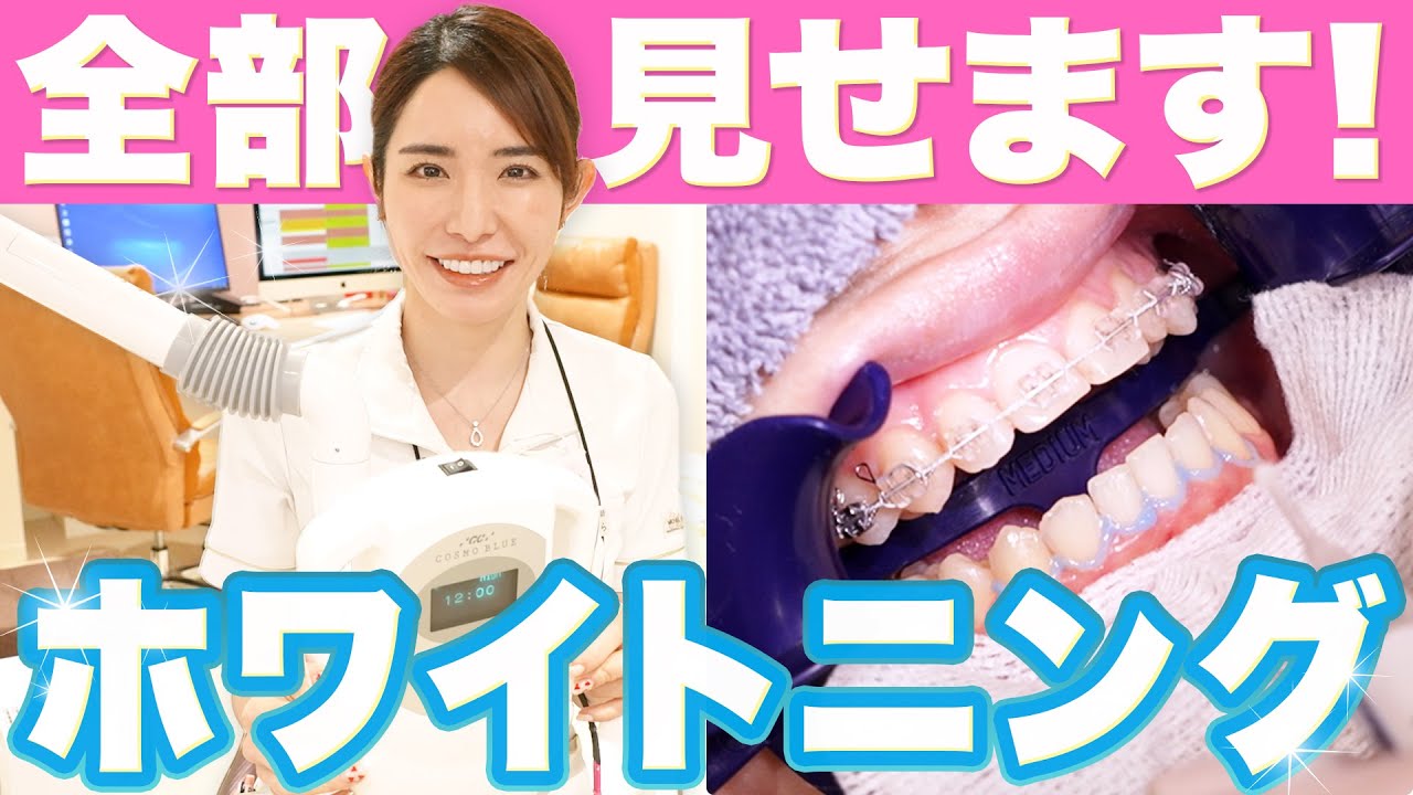 【本気で歯を白くする】歯医者の最強ホワイトニングを全部見せます。