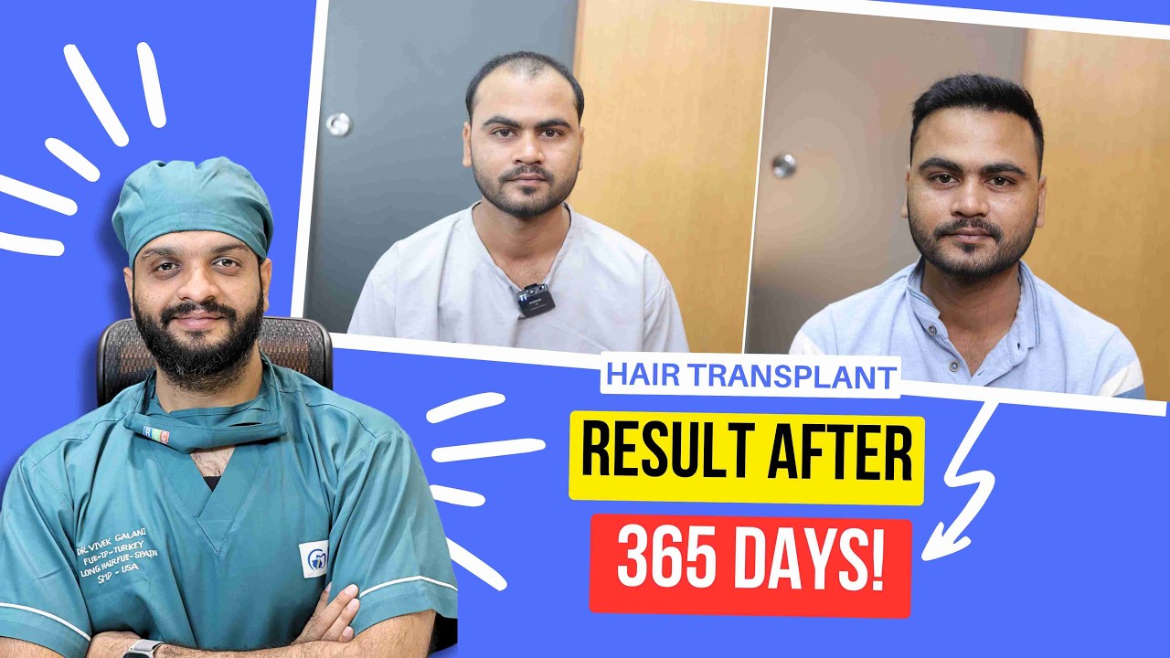 Before and After Hair Transplant Results in Baldness of Hair | Androgenic baldness treatment | RQC