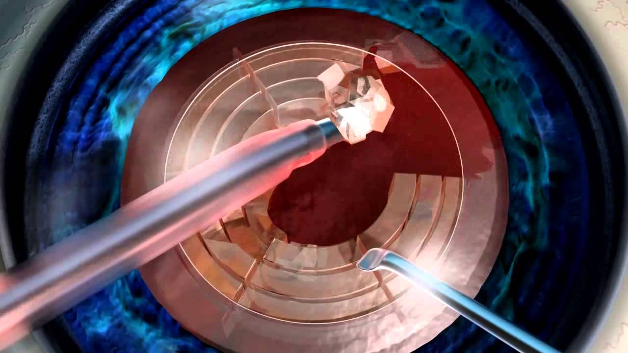 Laser-Assisted Cataract Surgery @ Eye Medical Center of Fresno