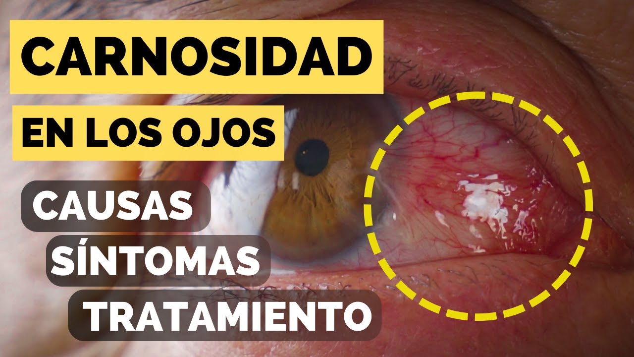 Carnosidad en los Ojos, Causas, Síntomas y Tratamiento Definitivo de Pterigión. Dra Mira Oftalmologo