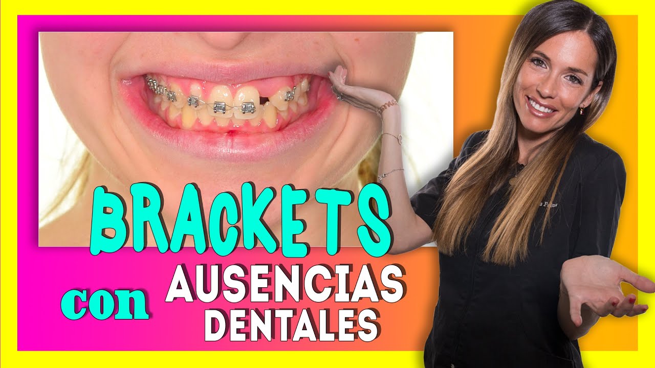 🧐¿Se pueden 𝗣𝗢𝗡𝗘𝗥 𝗕𝗥𝗔𝗖𝗞𝗘𝗧𝗦 si faltan MUELAS O DIENTES? Ortodoncia con AUSENCIA de DIENTES 😱