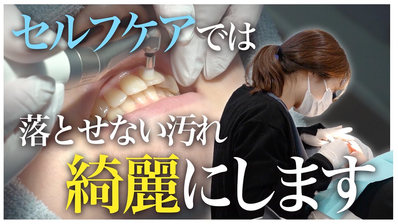 歯医者でセルフケアでは落としきれない汚れを綺麗にします✨【名古屋あおい歯科・矯正歯科】