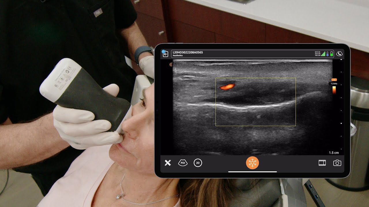 Ultrasound Anatomy of the Nasolabial Fold