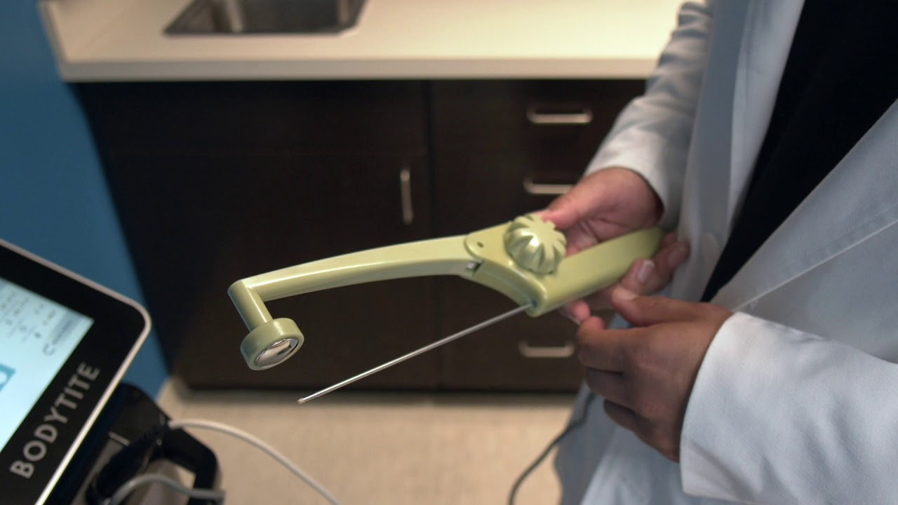 BodyTite Radio-Frequency Assisted Lipolysis (RFAL)