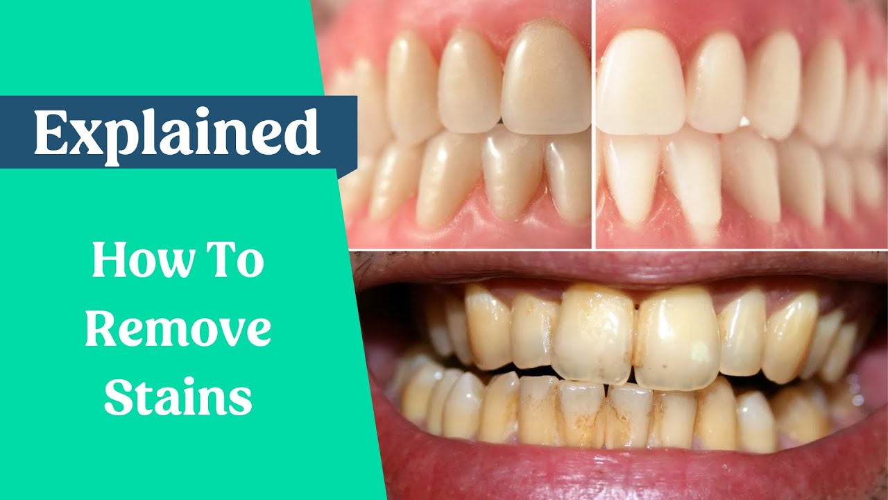 How to remove stains from the teeth **UPDATED VIDEO**