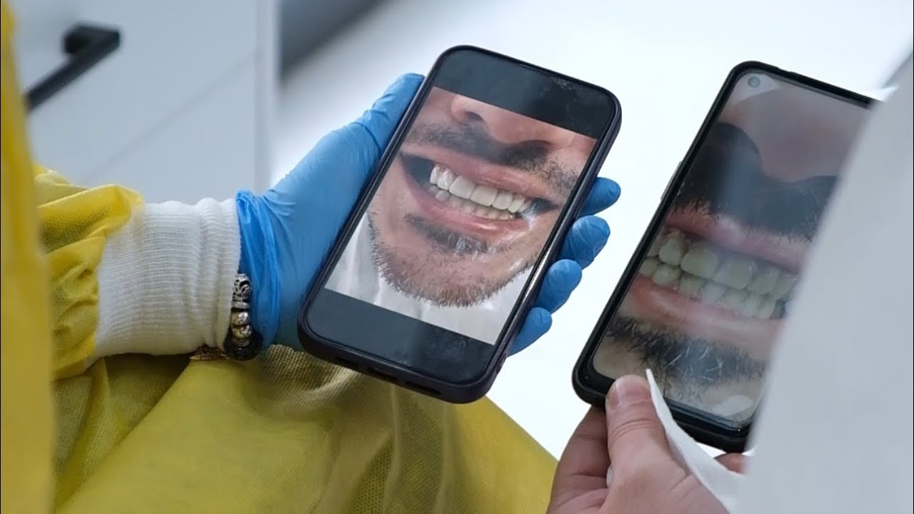 Lamine Simantasyonu | Hollywood Smile
