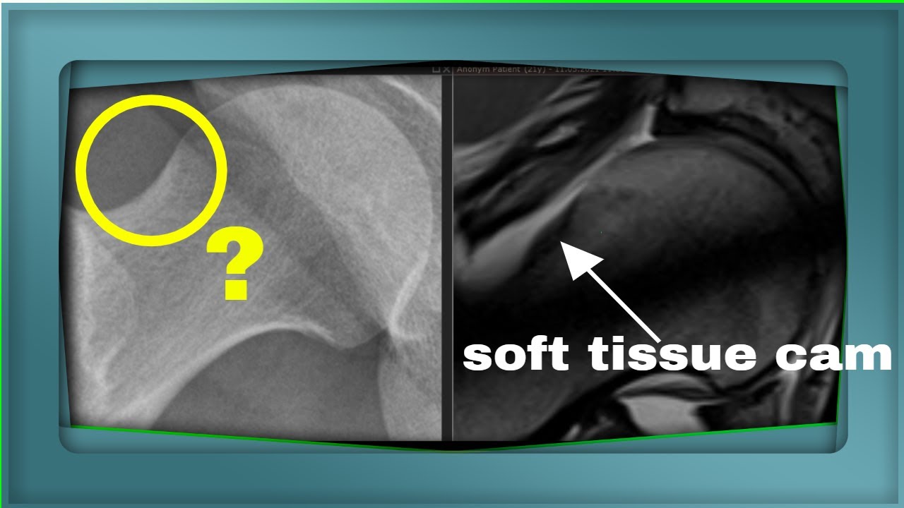 Hip MRI: Soft Tissue Cam Lesions in Adolescents (Case Study)