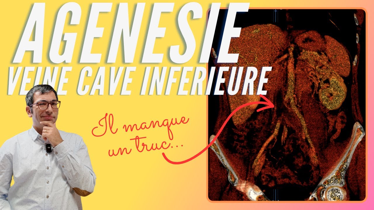 Une phl&eacute;bite extensive chez un homme jeune sans ant&eacute;c&eacute;dent : ag&eacute;n&eacute;sie de la VCI