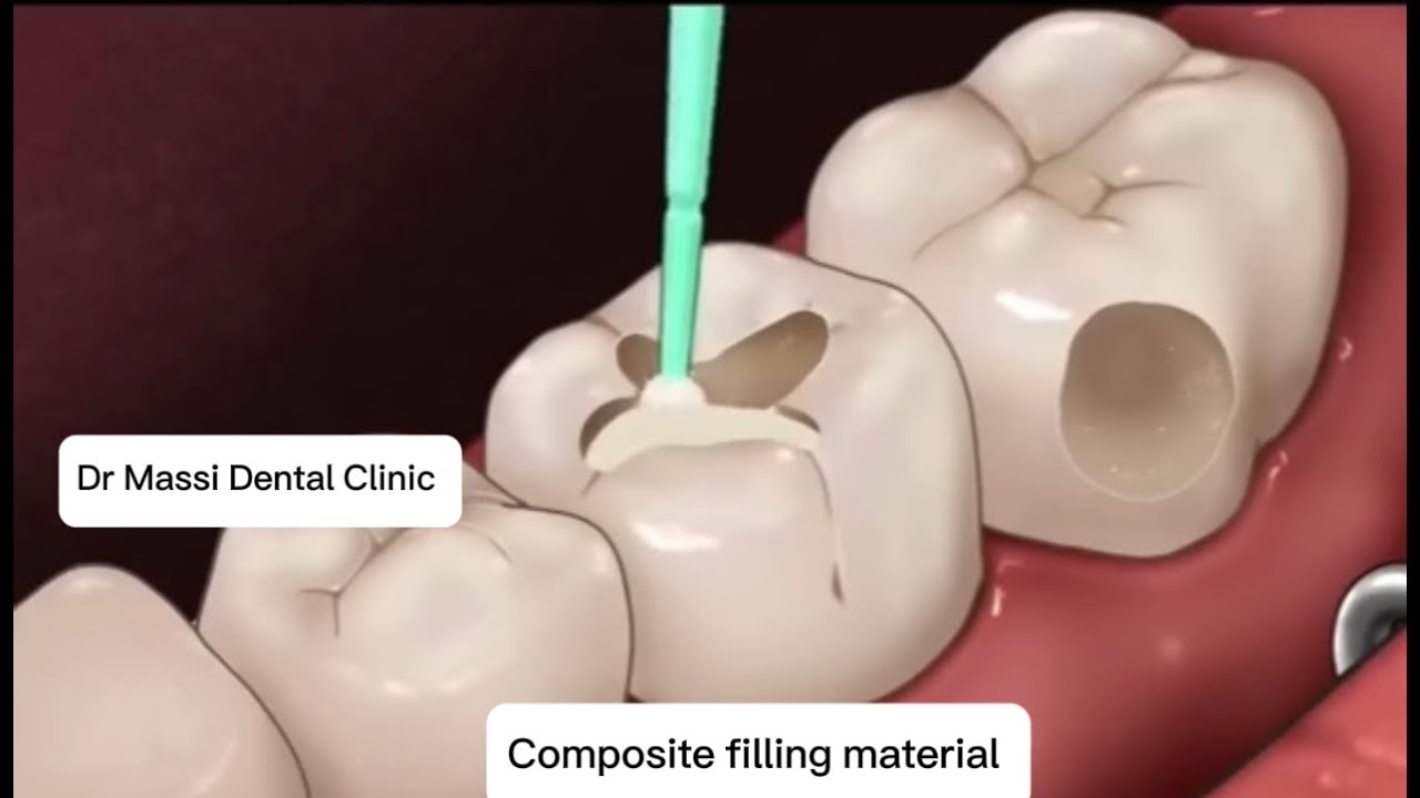composite filling procedures