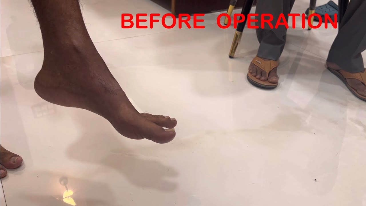 Before Operation and 2 Months after Operation (Foot deformity/ Foot drop)