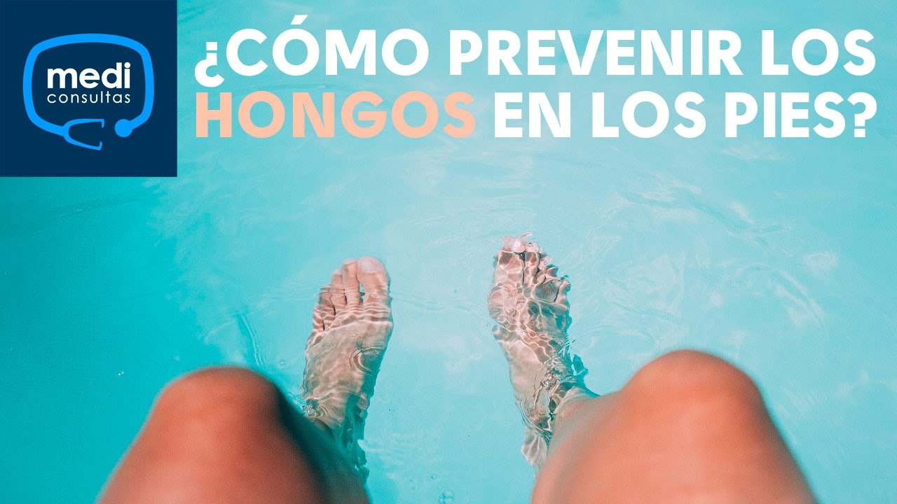 &iquest;C&oacute;mo puedo prevenir los hongos en los pies? #MediConsultas
