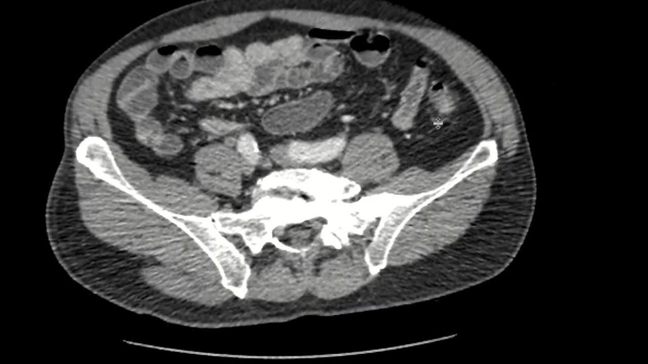 Liquid stool on CT