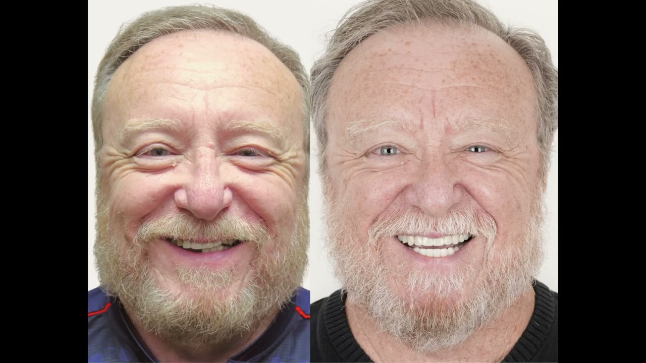 Patient Stories: Shawn | Holger Dental Group