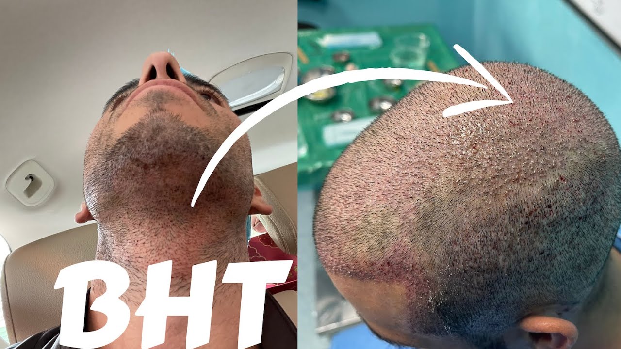 Everything You Need to Know About BHT (Beard Hair Transplants)