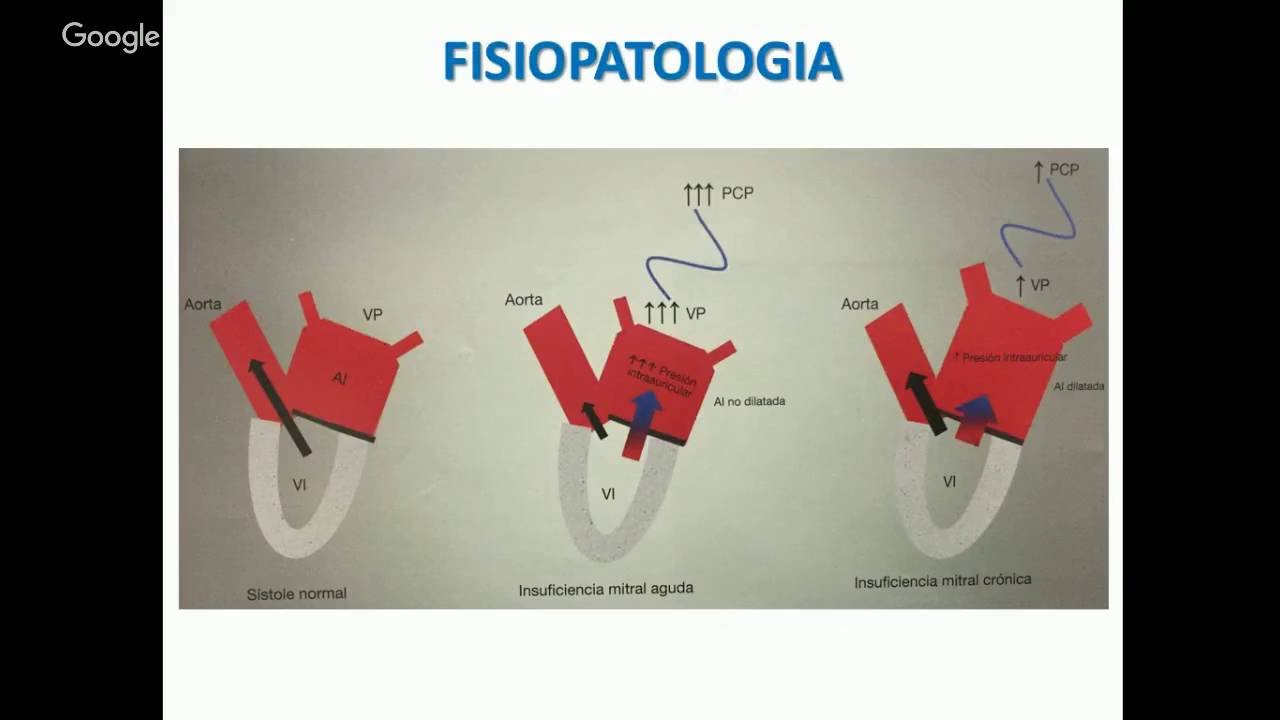 INSUFICIENCIA MITRAL