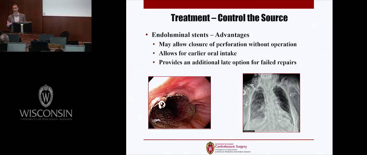 Current Strategies for Managing the Perforated Esophagus