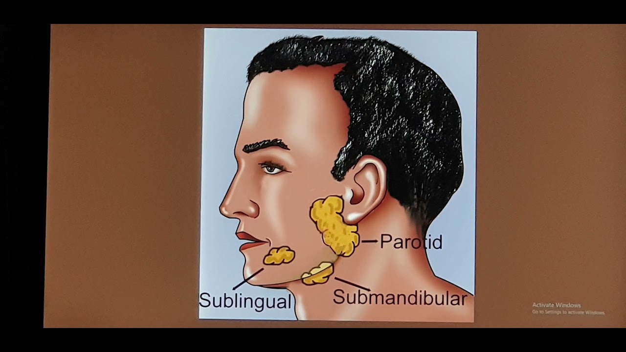 Salivary gland stones Patient teaching programme Hindi