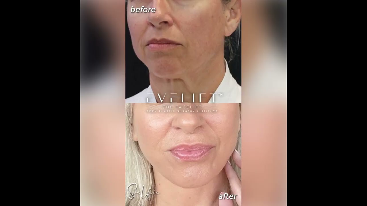 Patient Before and 4 Months After EVE Lift™ | Eden Plastic Surgery: Dr. Ali Charafeddine, MD