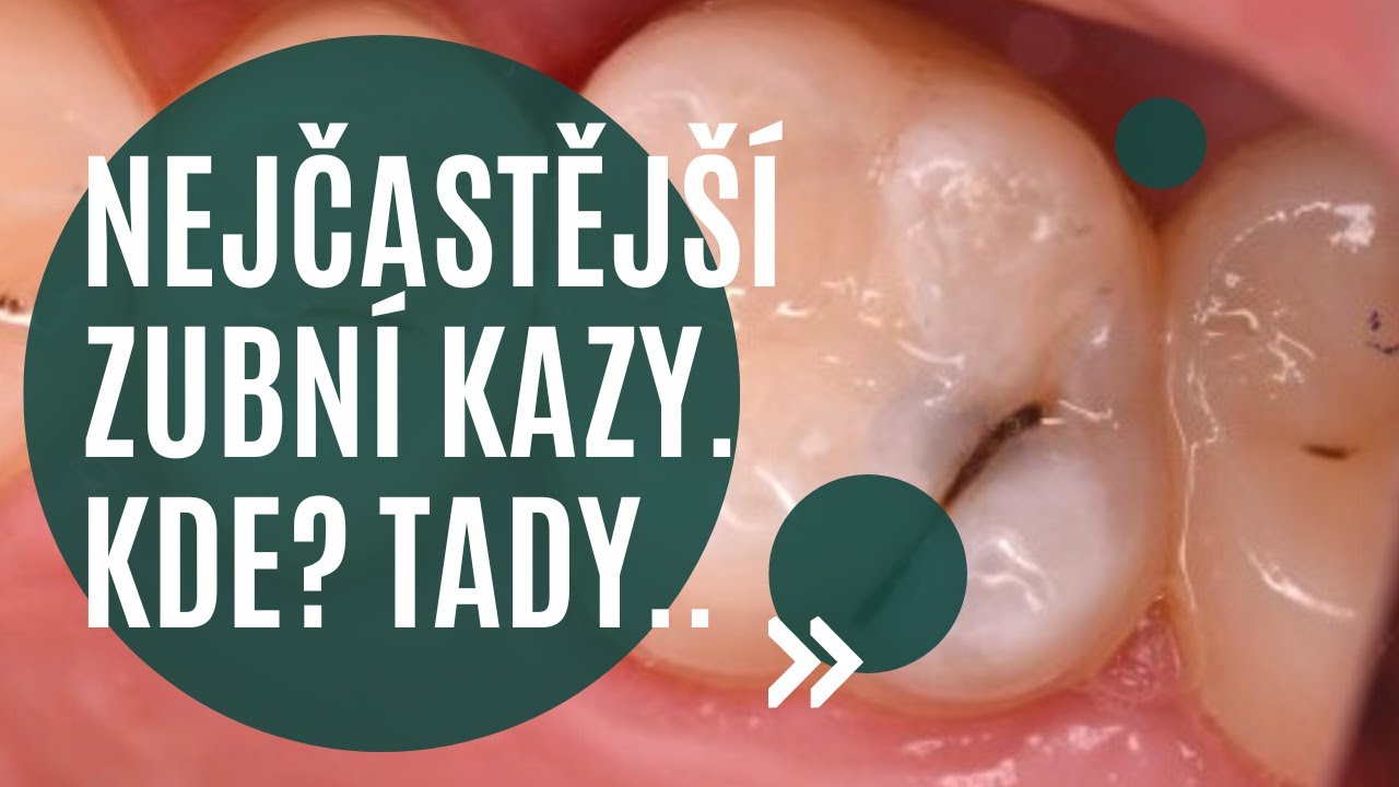 🫣📌 Kde nalezne zubař nejčastější zubní kazy? Kde si dávat větší pozor při čištění? 👀