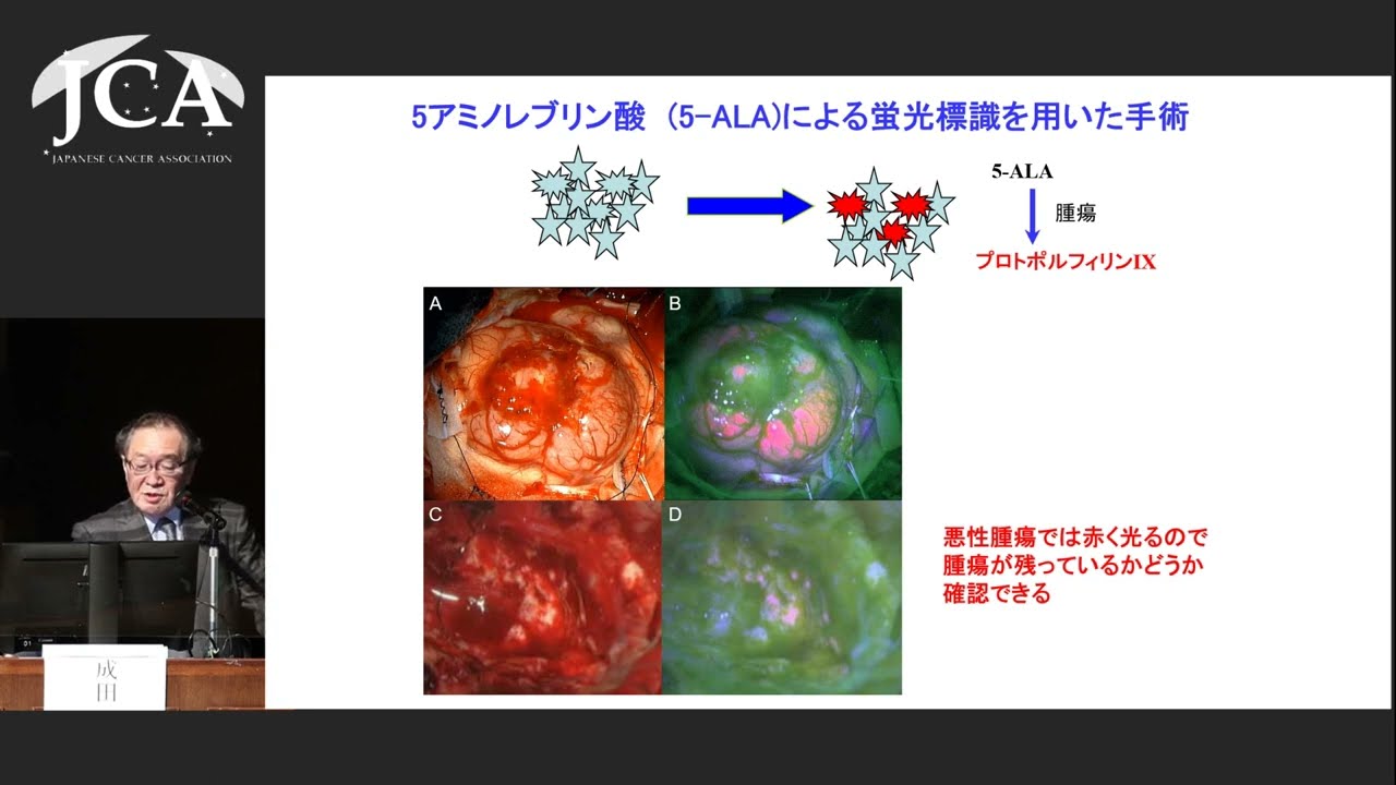 講演3「脳腫瘍の診断と治療」成田 善孝（国立がん研究センター中央病院 脳脊髄腫瘍科 科長）