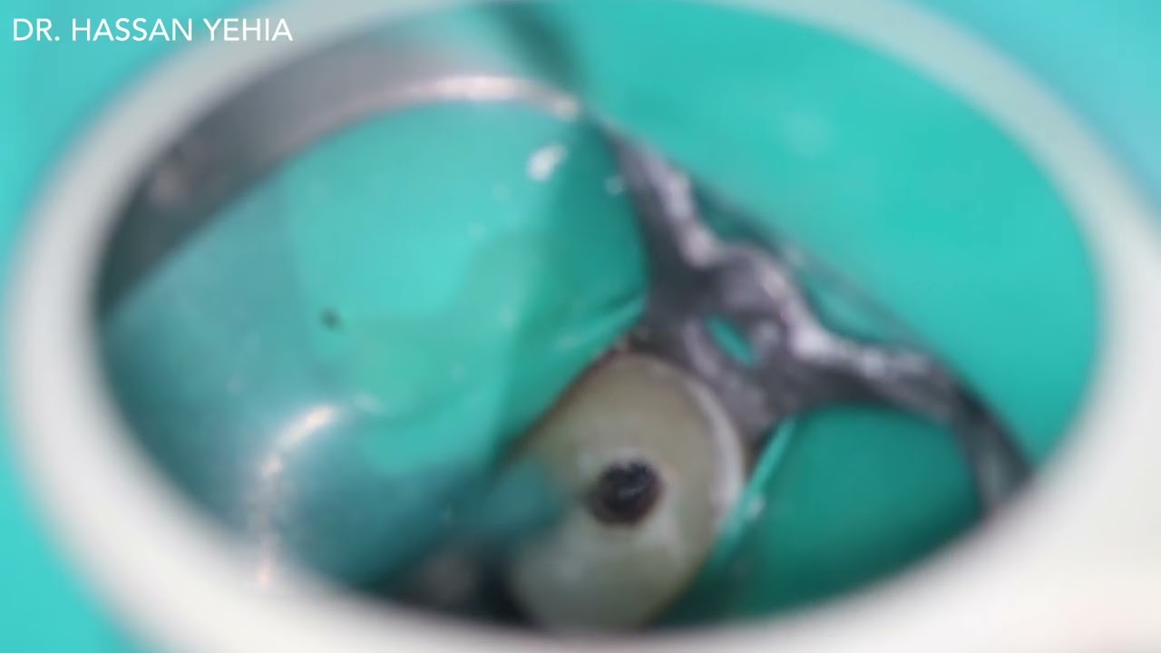 How to Remove a Separated Root Canal File - Step by Step Endodontic Tutorial