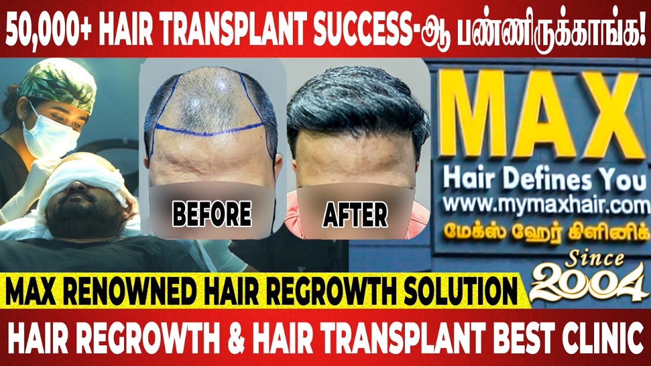 Top Celebrities Hair Treatment-க்கு இங்கதான் வருவாங்க! | Max Hair Clinic | Hair Regrowth | Hair Loss