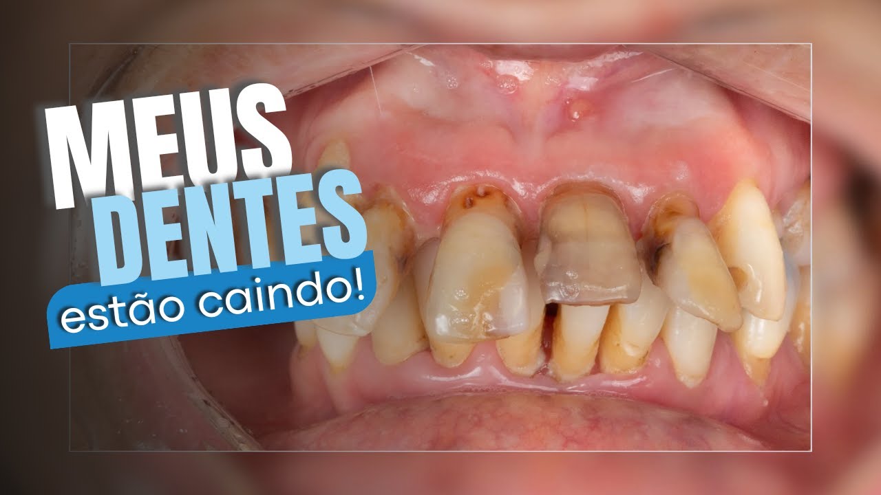 Existe solução para quem perde todos os dentes?