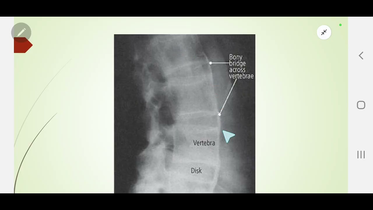 Ankylosing spondylitis - Rheumatic conditions