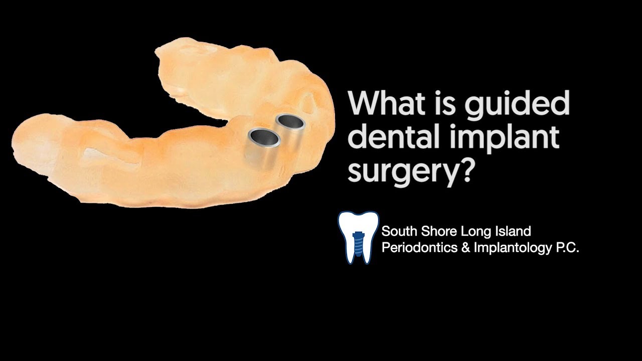 Guided full arch replacement - peace of mind in precision!
