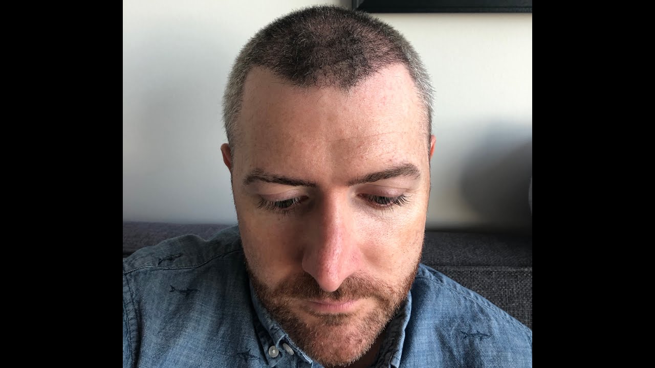 HAIR TRANSPLANT JOURNEY - Day 18 - HLC Ankara