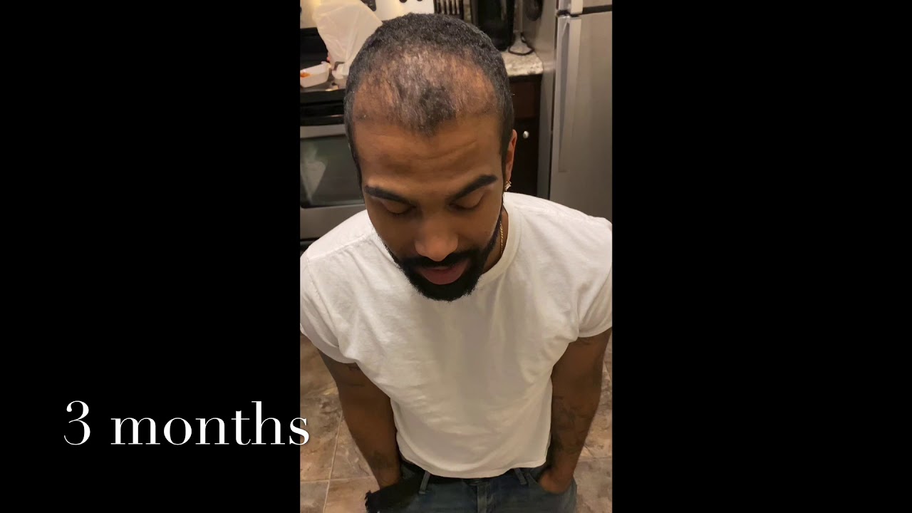 3 Month & 4 month  Post Op - African American Hair Transplant FUE
