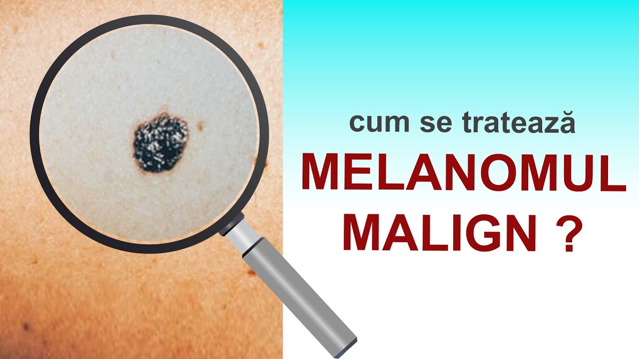 Melanomul, cel mai agresiv cancer de piele: tratament în stadiu incipient și în stadiu avansat