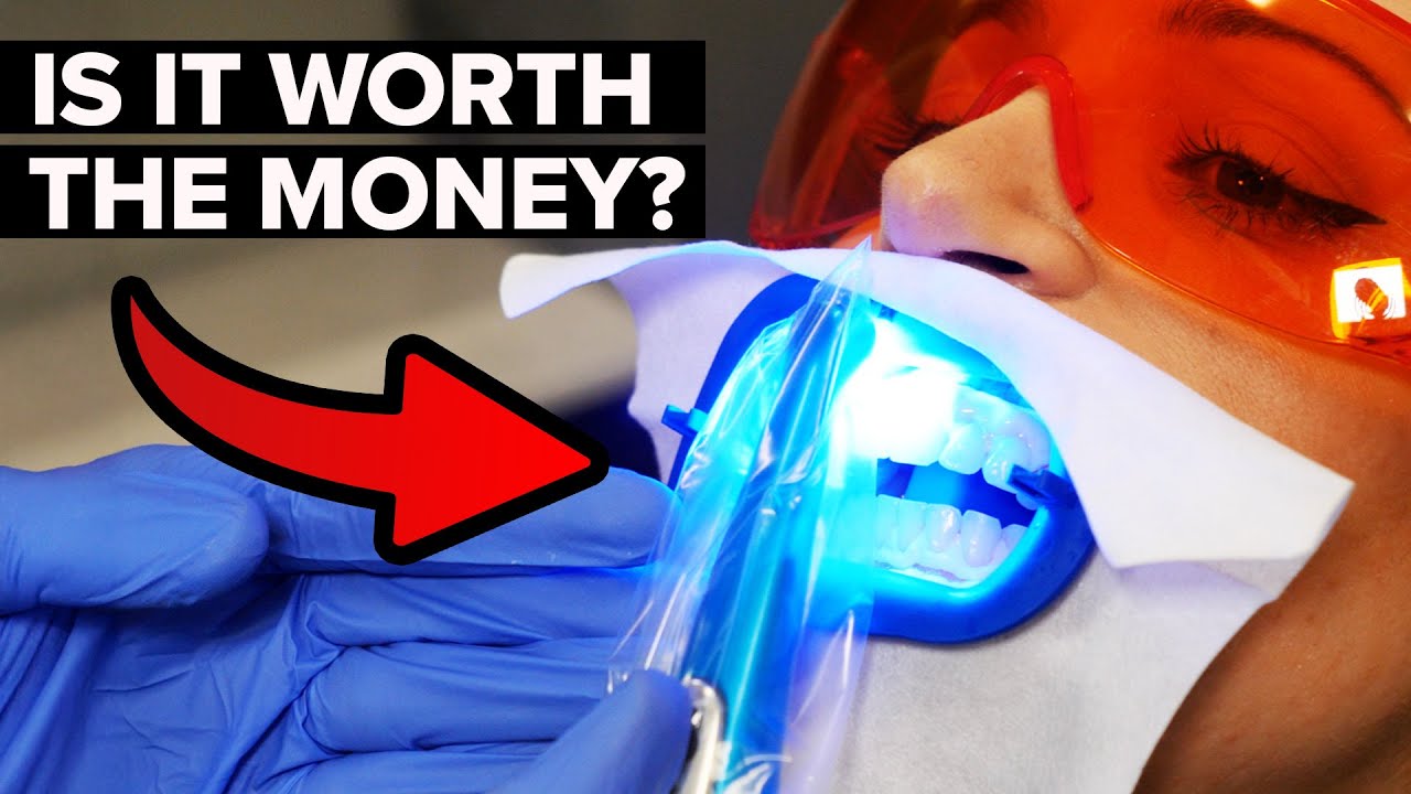 Over-the-Counter vs. Professional Teeth Whitening