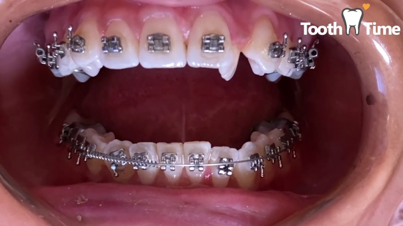Braces Regular Check ups - Two Coil Springs - 3 months in braces - Tooth Time New Braunfels