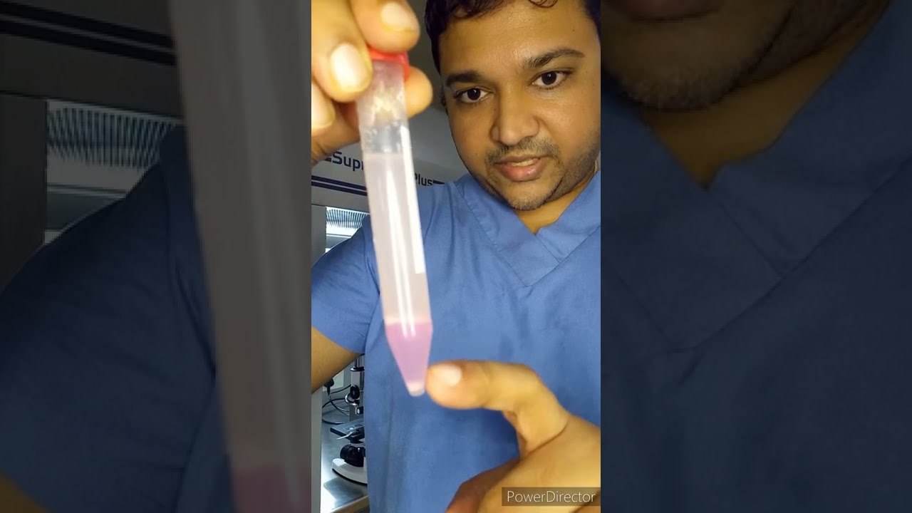 IUI Treatment in PCOS wife with medium count husband