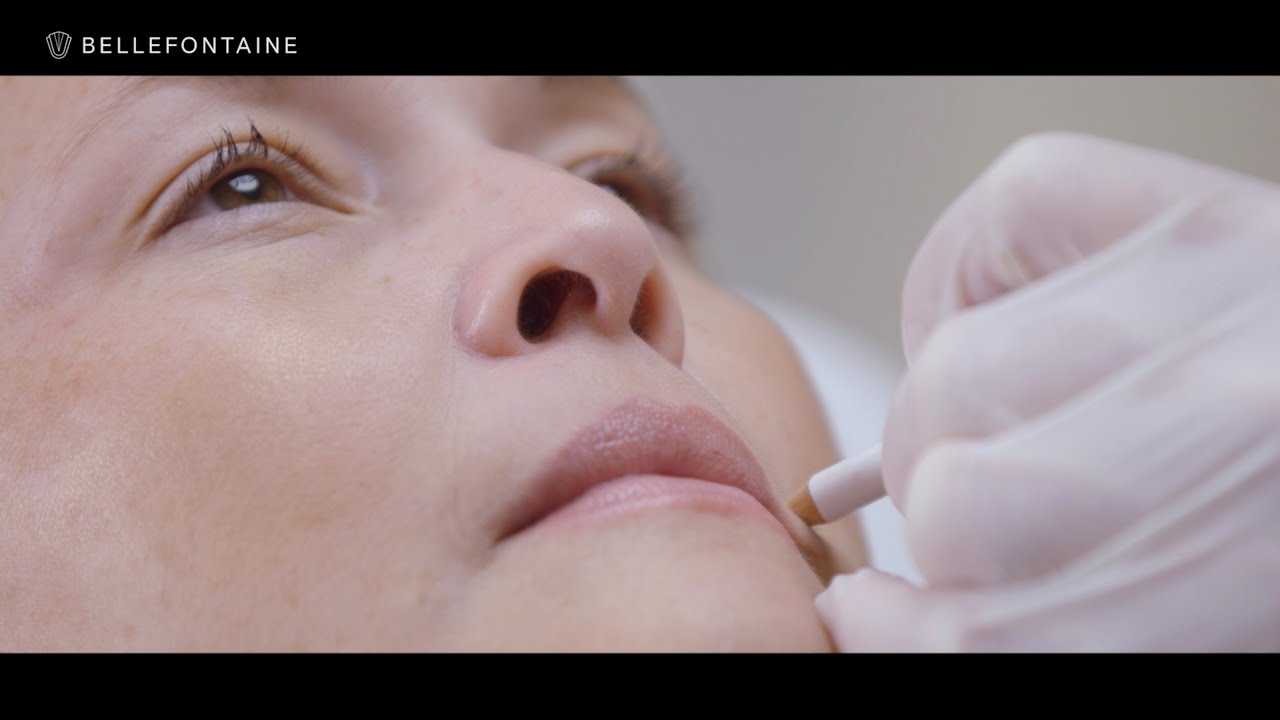 ACIDE HYALURONIQUE - INJECTION JUVEDERM - FILLER - CLINIQUE BELLEFONTAINE - LAUSANNE