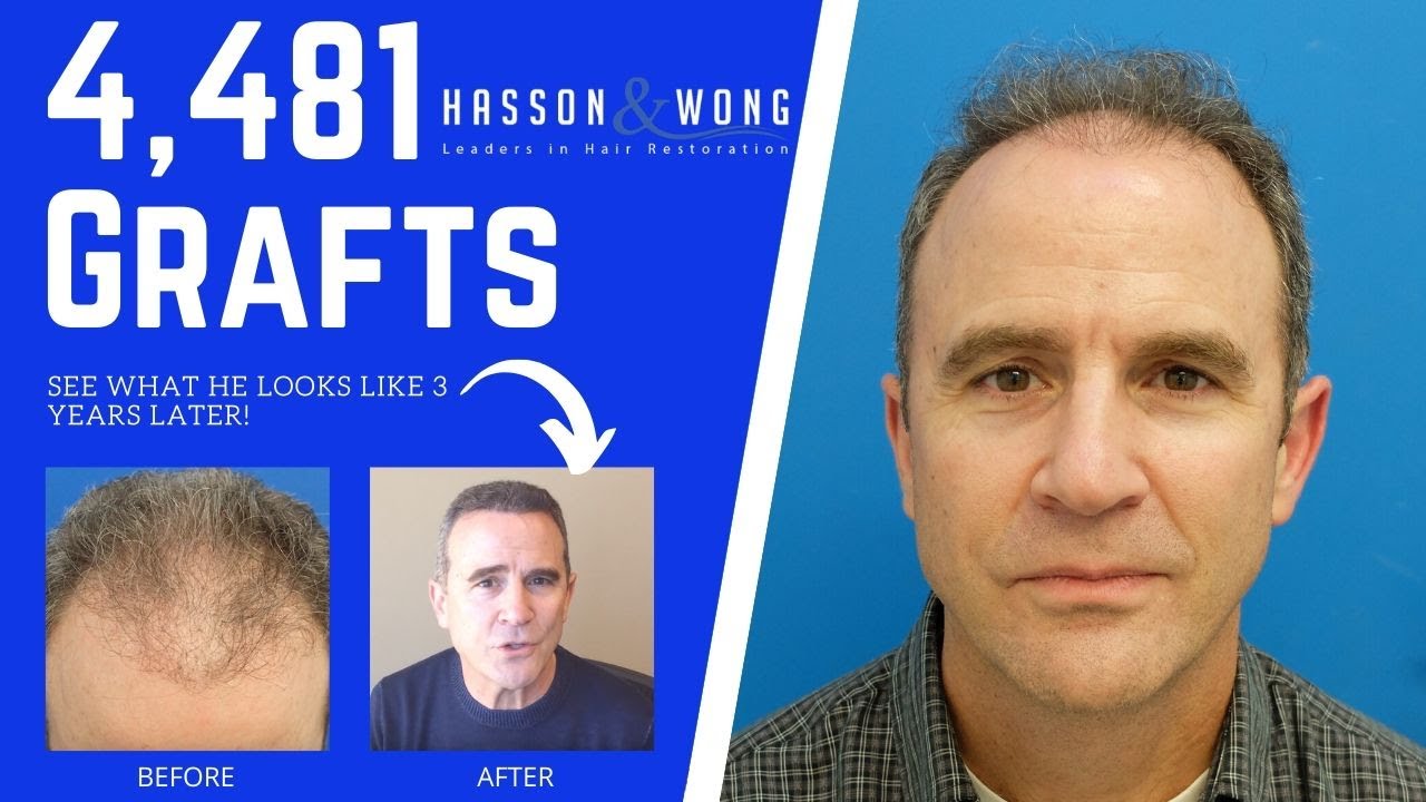 4481 hair transplant FUT | Hair Transplant Repair | 3 years Post-Op