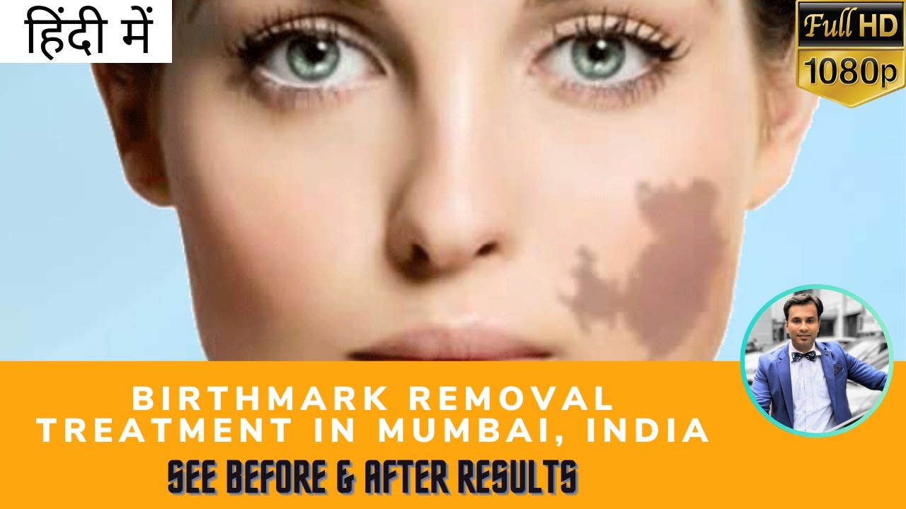 (हिंदी में) Birthmark Removal, Laser & Permanent Tattoo Removal Treatment in Mumbai, Before After