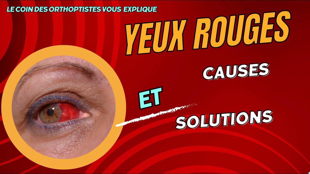 Yeux rouges et irrités: Découvrez les solutions et les traitements