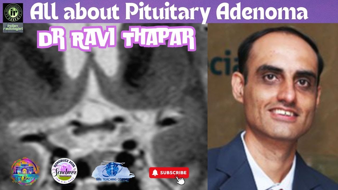 PITUITARY ADENOMA | Dr Ravi Thapar #mriteaching #indianradiologist