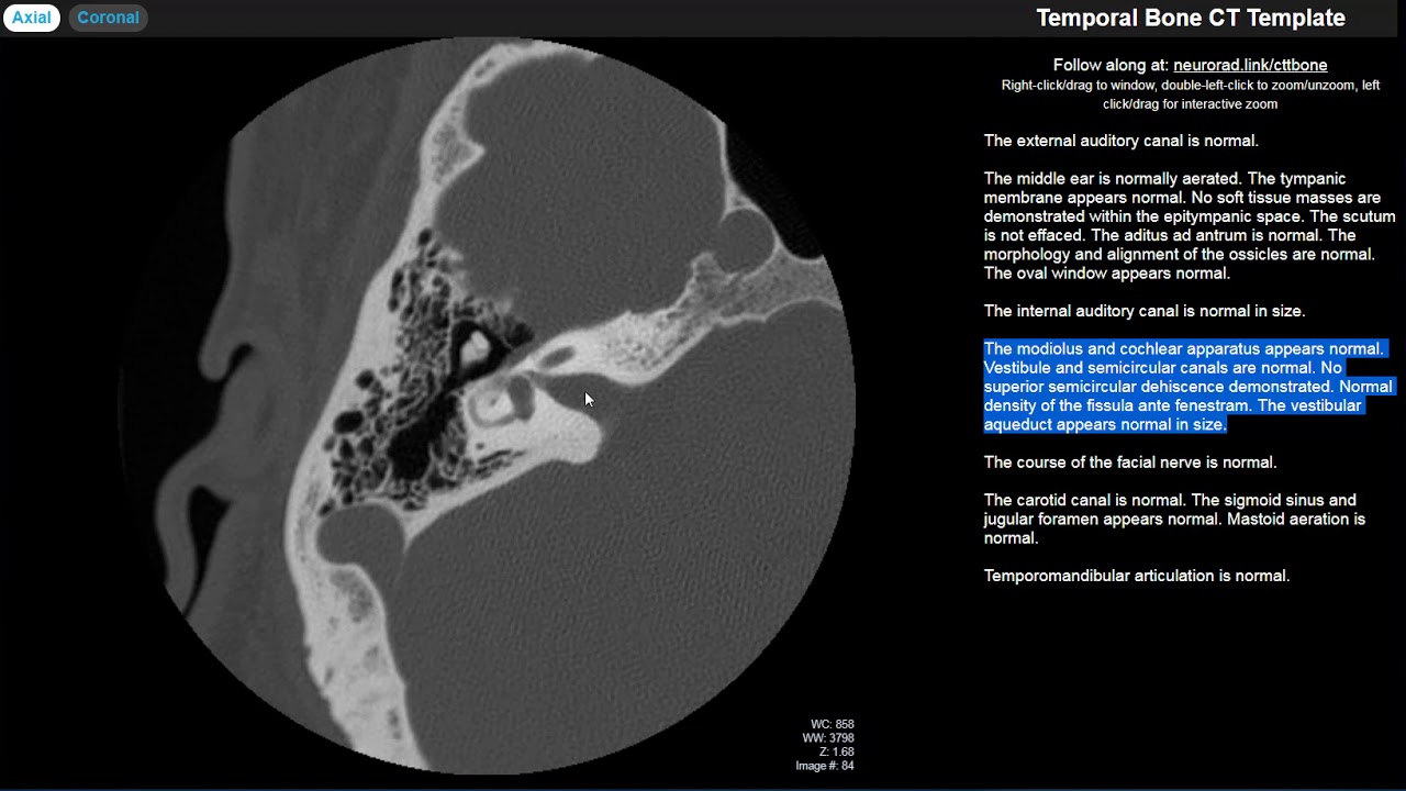 Radiology Walkthroughs - CT Temporal Bone Anatomy
