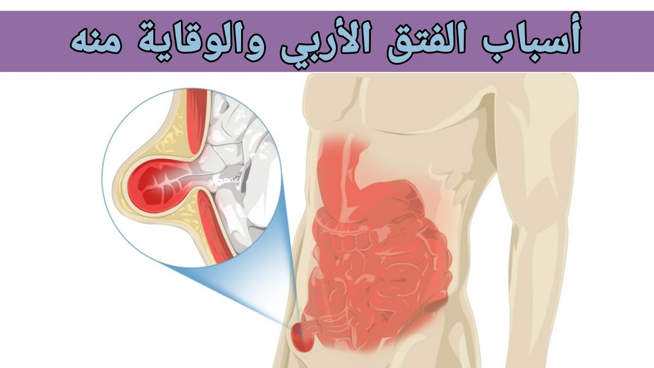 الفتق الاربي ، تعرّف على تفاصيل صادمة حوله .لماذا يجب أن تهتم به