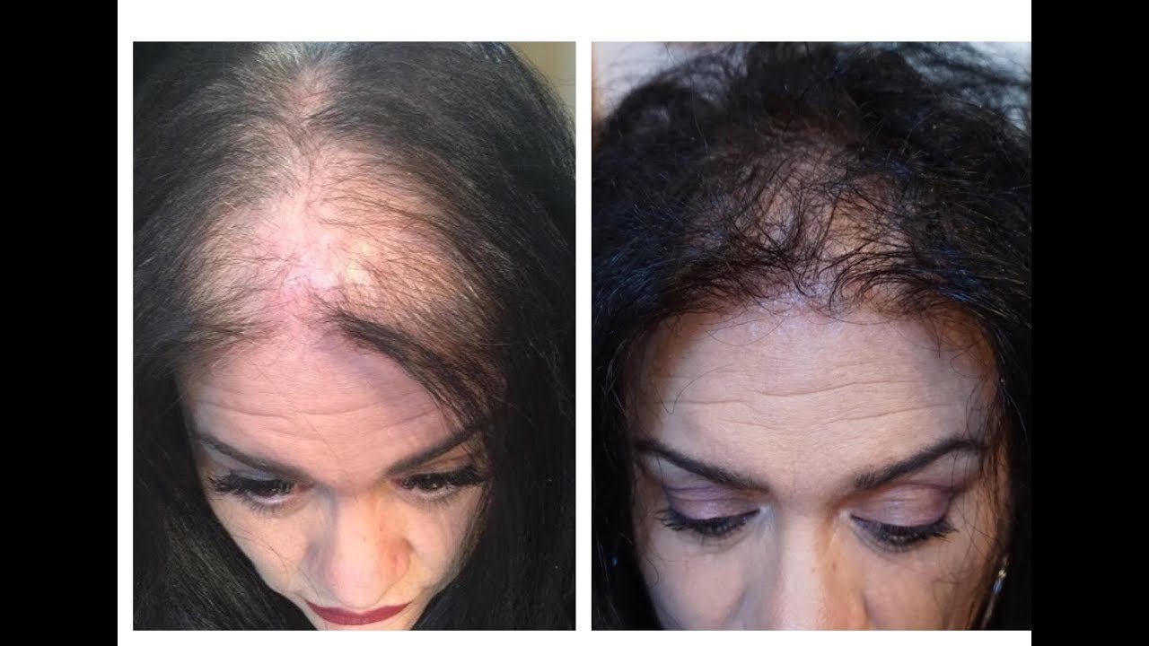 AMAZING Hair Growth UPDATE VIDEO PROOF 10/5/17