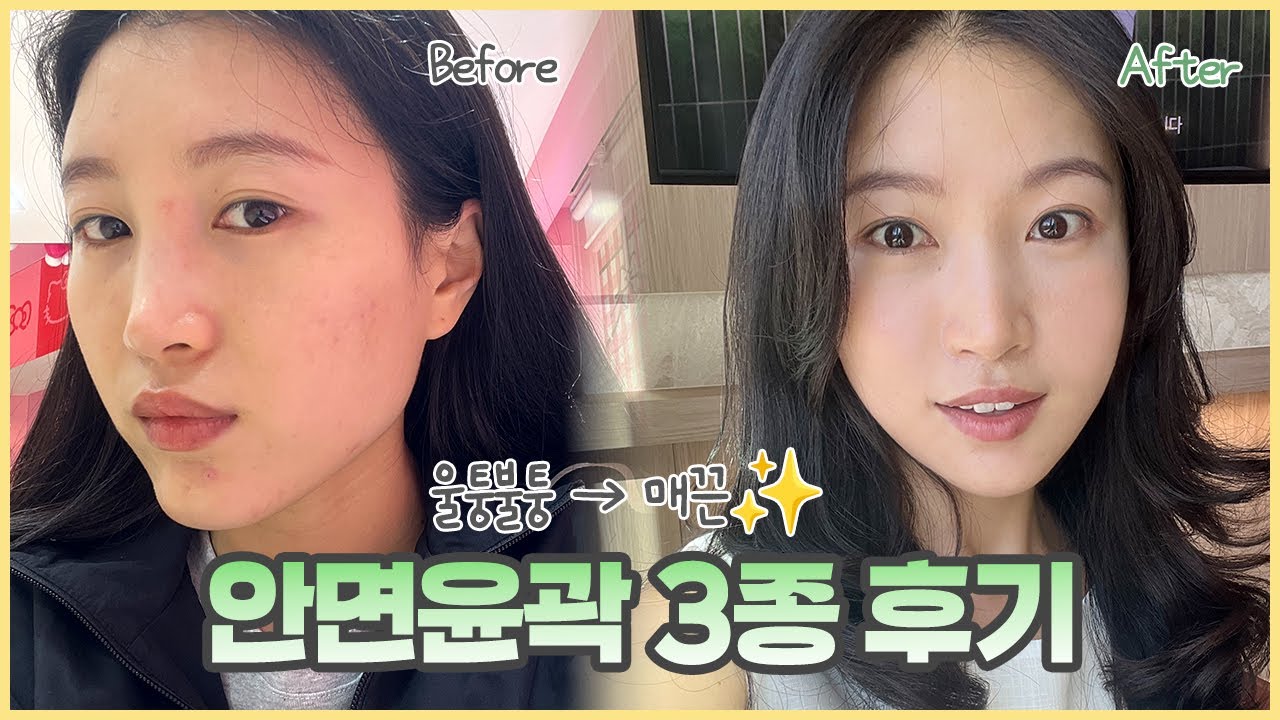[글램성형외과] 안면윤곽3종 성형브이로그 | 매끈한 얼굴 라인👍