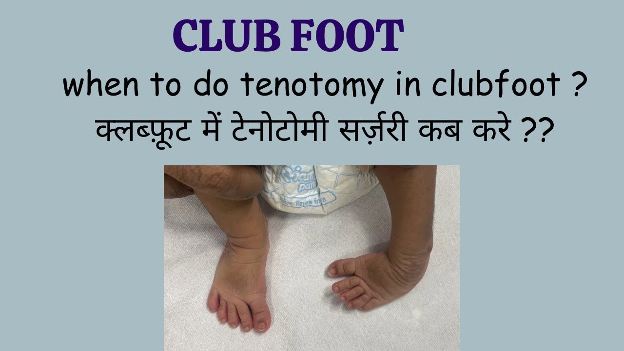 When to do Tenotomy in clubfoot, क्लब्फ़ूट में सर्जरी (टेनोटोमी) कब करे? @childorthocare #childortho